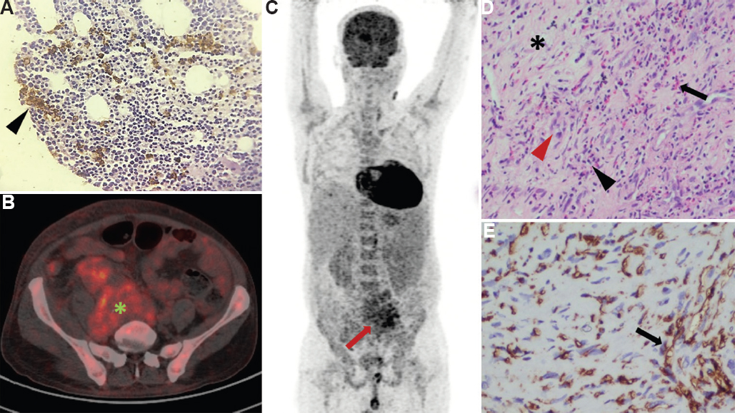 (A) Bone marrow immunohistochemistry showing eosinophilic precursors with no abnormal cells (black arrowhead). (B) Cross-section of positron emission tomography-computed tomography (PET-CT) showing FDG-avid irregular retroperitoneal mass (green asterisk). (C) Maximum intensity projection of PET-CT showing FDG-avid retroperitoneal mass (red arrow). (D) Histopathology of the retroperitoneal mass showing fibrosis (black asterisk), obliterative phlebitis (red arrowhead), lymphoplasmacytic (black arrowhead) and eosinophilic infiltrate (black arrow). (E) Immunohistochemistry of the biopsy showing IgG4-positive plasma cells staining brown (black arrow).